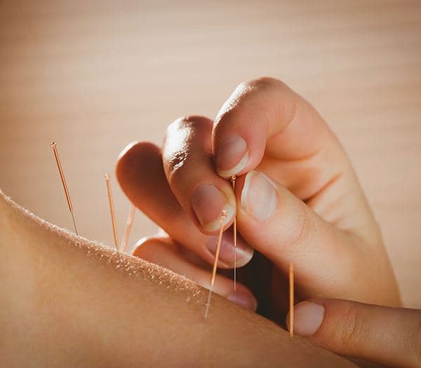 female hand putting Acupuncture needles